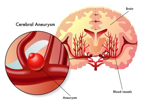 Cerebral Aneurysm Repair by Endovascular Embolization by OrangeCountySurgeons 